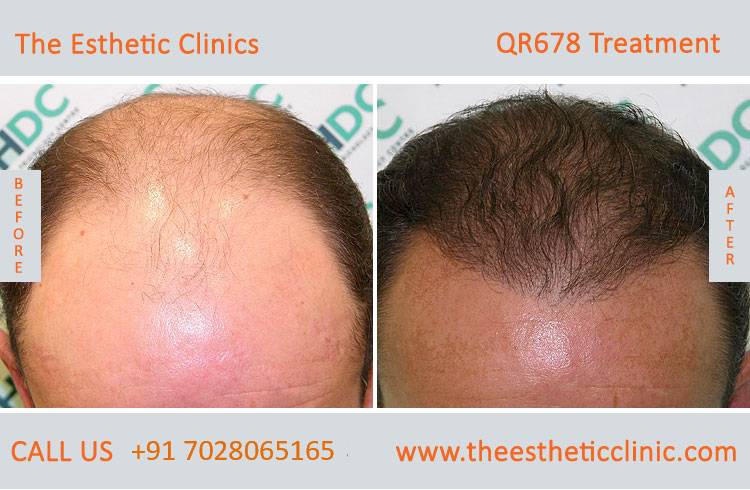 qr678 treatment, qr678 hair injection injection before after photos in mumbai india (5)